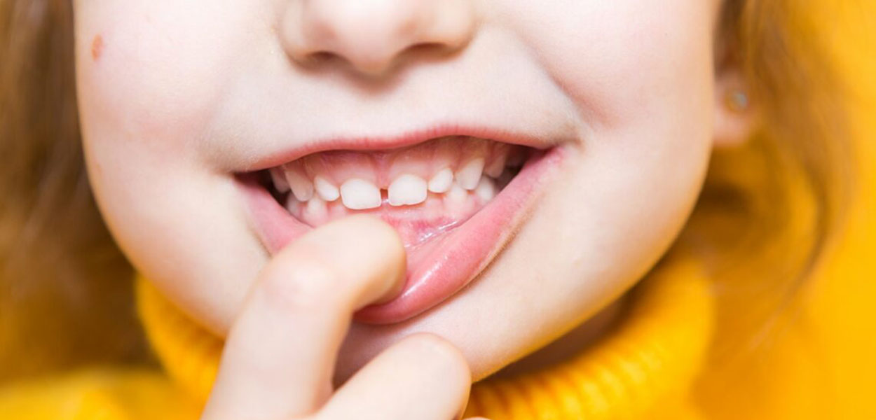 Overjet In ChildrenPrevent Tooth Trauma