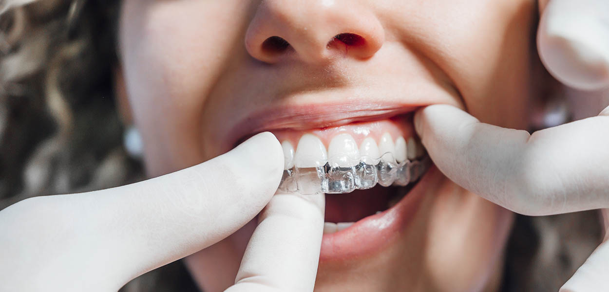 clear aligners north shore orthodontist