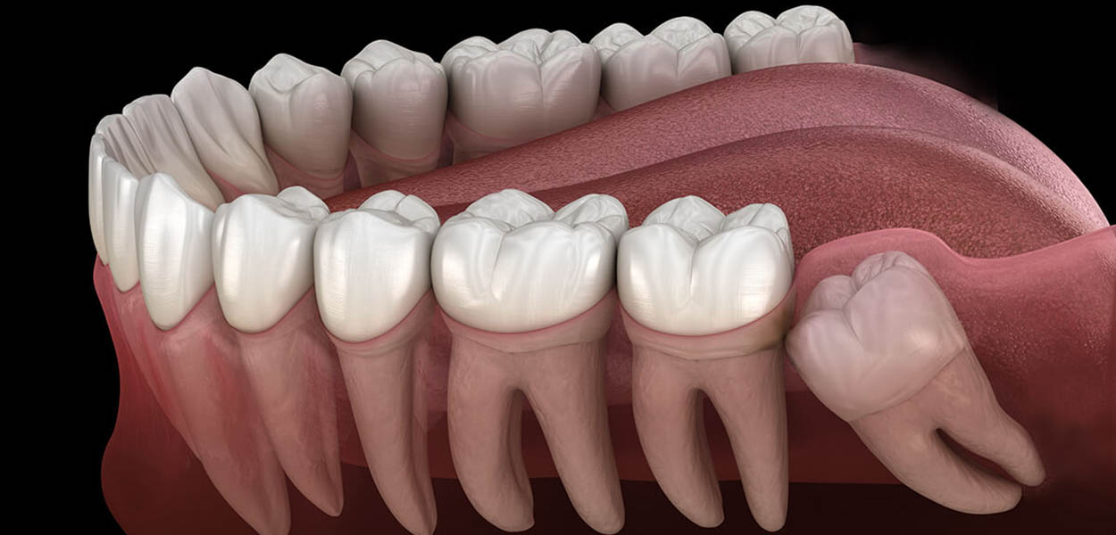 impacted tooth and orthodontics