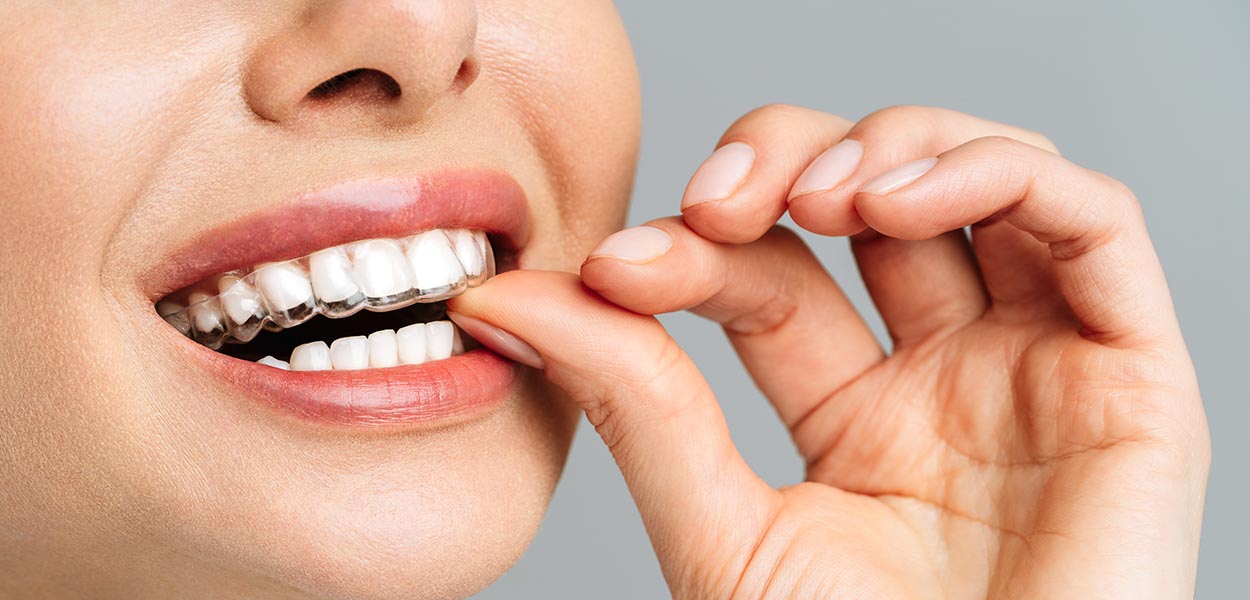 invisalign treatment by expert provider
