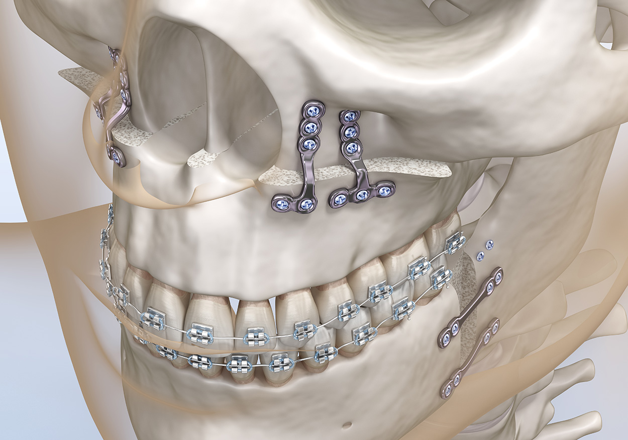 Orthognathic Surgery